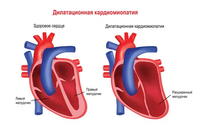 При миопатии Дюшенна нарушается поглощение митоходриями ионов кальция