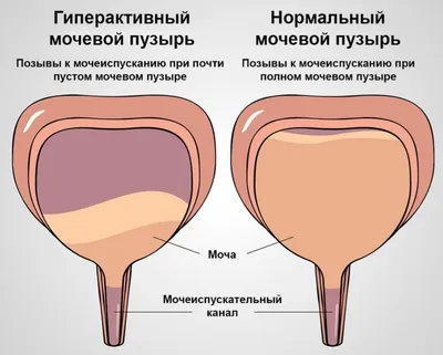 Гиперактивный мочевой пузырь, лечение в Хабаровске - Медикъ