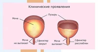 Нейрогенный мочевой пузырь: причины патологии, симптомы, диагностика и  лечение