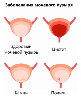 Основная информация: Рак мочевого пузыря - Справочник MSD Версия для  потребителей