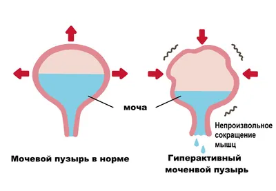 Гиперактивный мочевой пузырь - симптомы по дням у детей и взрослых,  диагностика и способы лечения