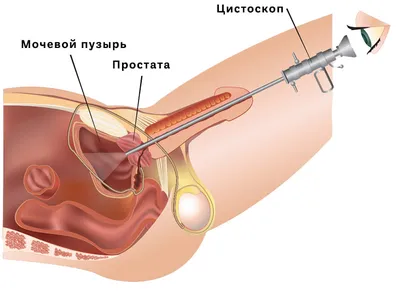 Инстилляция мочевого пузыря : цена в Одессе