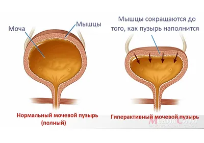 Нейрогенный мочевой пузырь. Дисфункция мочевого пузыря. Непроизвольное  мочеиспускание