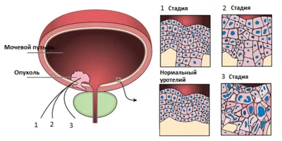 Заболевание мочевого пузыря | Медлаб