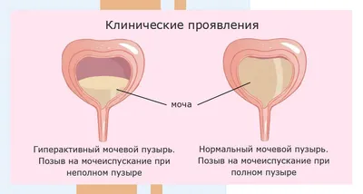 Нейрогенный мочевой пузырь: причины патологии, симптомы, диагностика и  лечение