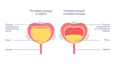 Лечение камннй в мочевом пузыре в Хабаровске - Медикъ