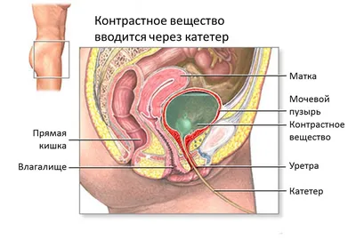 Рак мочевого пузыря | Первый клинический медицинский центр