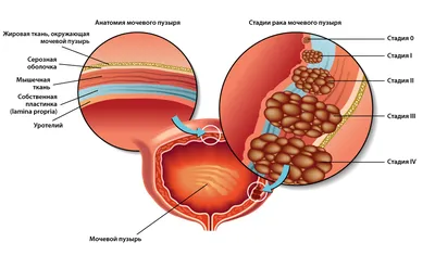 Стадии рака мочевого пузыря | Онкология в Израиле