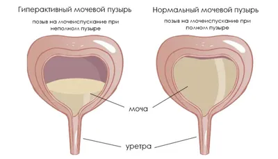 Рак мочевого пузыря - Доктор Мишугин