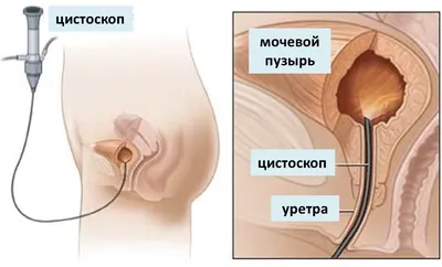 Цистоскопия – исследование мочевого пузыря: показания, противопоказания.  Как проводится цистоскопия