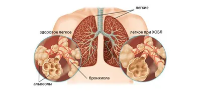 Абсцесс легкого - причины появления, симптомы заболевания, диагностика и  способы лечения