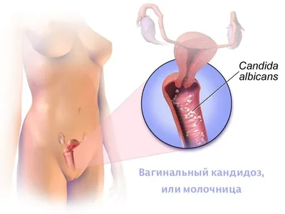 Кандидоз слизистой полости рта (молочница) - добрый доктор