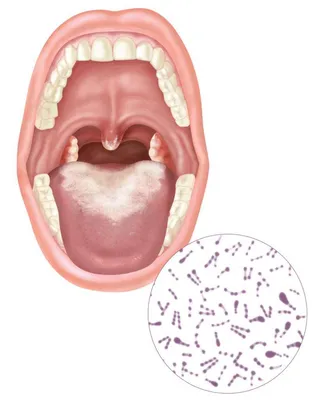 Молочница (кандидоз) во рту - лечение, виды и причины болезни