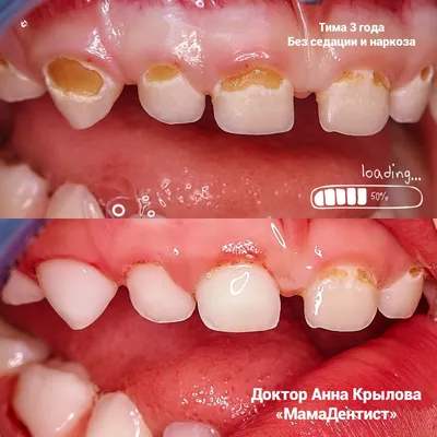 Лечение молочных зубов у детей без боли и наркоза