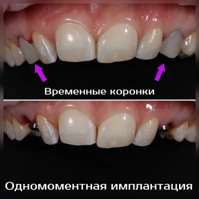 ДЛЯ ЧЕГО ЛЕЧИТЬ МОЛОЧНЫЕ ЗУБЫ, ЕСЛИ ОНИ ВСЁ РАВНО ВЫПАДУТ? Не скупитесь на  ❤, пожалуйста. Часто бабушки говорят: \"Что там - молочные… | Instagram