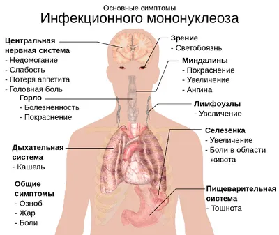 Инфекционный мононуклеоз: симптомы, лечение, причины и диагностика