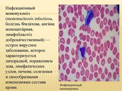 К вопросу клиники инфекционного мононуклеоза у взрослых – тема научной  статьи по клинической медицине читайте бесплатно текст  научно-исследовательской работы в электронной библиотеке КиберЛенинка