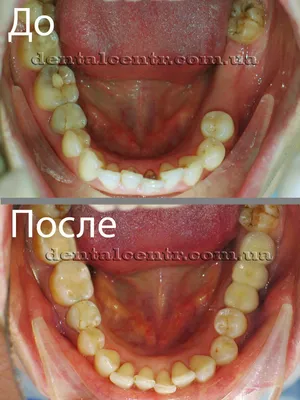 Зубной мост - поставить на 2, 3, 4 зуба – цена в стоматологии Vimontale