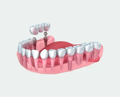 5 фактов о вреде мостовидных протезов на свои зубы | Стоматология  Smile-at-Once | Дзен