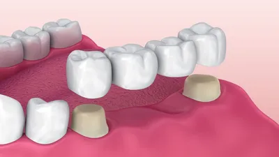 Мостовидные зубные протезы | Металлопластмассовый мостовидный протез - цена  в 32Dent