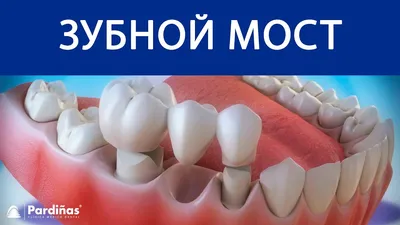 Мостовидные протезы в стоматологии – когда они нужны?