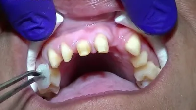 Восстановление 2-х зубов - зубной имплант или зубной мост? - YouTube