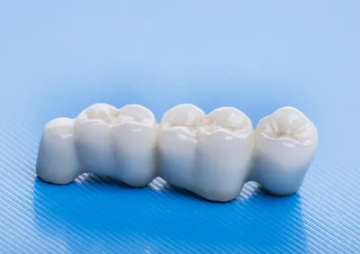 Зубной мост на имплантах — преимущества и недостатки метода