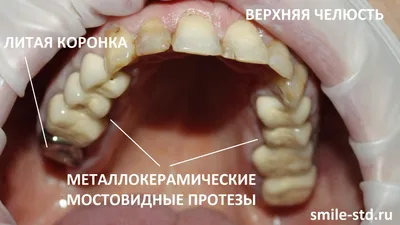 Замена металокерамического моста на зубной имплант в Харькове