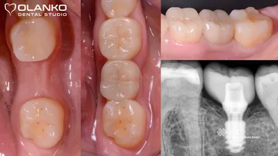 Что важно знать пациентам перед установкой зубного моста? - Хирургическая  стоматология