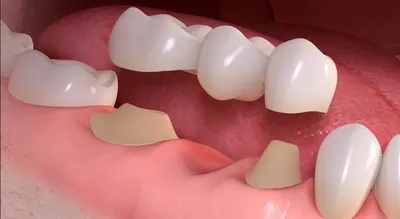 Шатается зубной мост – причины и как с этим бороться, как укрепить протез