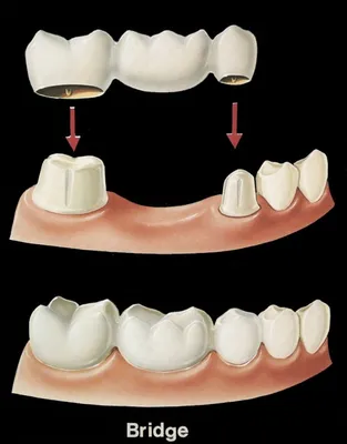 Мостовидный протез, зубной мост или имплант ⋆ Стоматология Оланко™