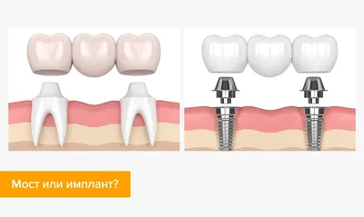Мостовидные зубные протезы - мостовидные протезы-коронки