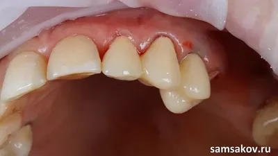 Протезирование, когда потерян только один зуб