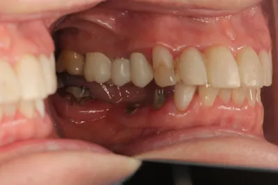 Имплант или мост - что лучше выбрать при протезировании жевательных и  передних зубов в стоматологии