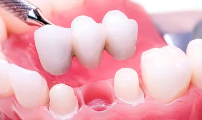 Металлокерамические мостовидные протезы: цены, установка на зубы -  Стоматология Елены Мокренко