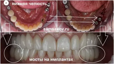 Зубной мост: цена на мостовидный протез в Нижнем Новгороде | Диагональ