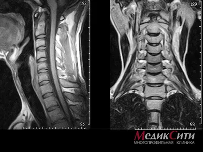 МРТ позвоночника (шейного, грудного, пояснично-крестцового отделов)