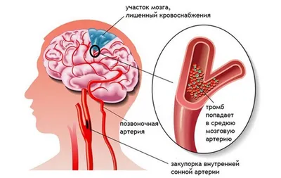 Мукормикоз фото