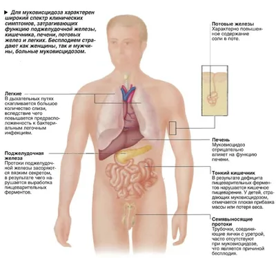 Муковисцидоз фото