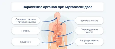 Муковисцидоз (кистозный фиброз) - причины появления, симптомы заболевания,  диагностика и способы лечения