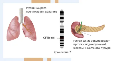 Лечение муковисцидоза в Израиле | Клиника Хадасса