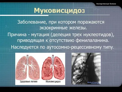 Может, лучше эвтаназия?»: честный рассказ красноярца, страдающего  муковисцидозом / Новости общества Красноярска и Красноярского края /  Newslab.Ru