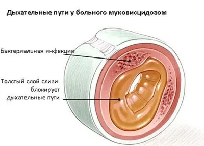 Муковисцидоз Что нам нужно знать Синево