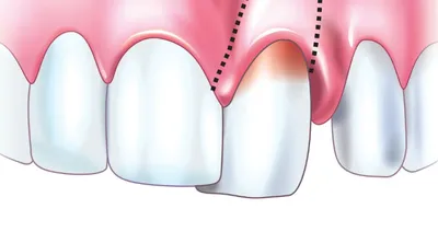 Гнойник на десне (абсцесс десны, зуба) – что делать, виды, методы лечения