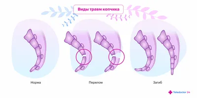 Гнойная киста копчика: причины и лечение нагноившегося эпителиального  копчикового хода