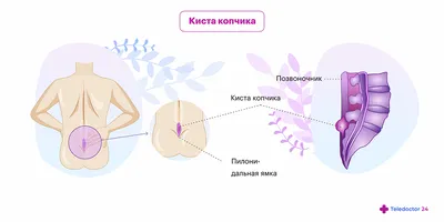 Болит копчик при беременности: причины, виды, лечение