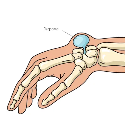 Шишка на запястье с внутренней стороны - гигрома: симптомы, причины, лечение
