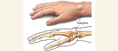 Шишка на запястье руки - Лечение