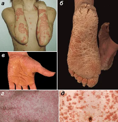 Псориаз, или чешуйчатый лишай | Демоскин - Эксперт в лечении демодекоза