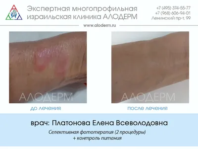 Какие ваши действия могут спровацировать псориаз? | Psoriaz.Life | Дзен